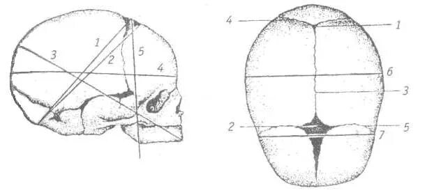 Стреловидный шов новорожденного. Стреловидный шов плода и роднички. Швы и роднички головки плода. Стреловидные шва плода.