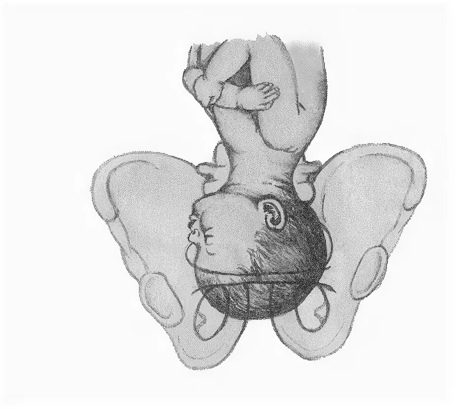 Переднеголовное предлежание плода биомеханизм родов. Биомеханизм родов в переднеголовном предлежании. Биомеханизм родов при переднеголовном предлежании плода. Переднеголовное предлежание головки плода. Переднеголовное предлежание