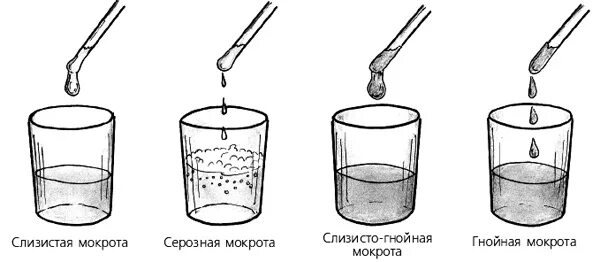 Мокрота слизисто гнойного характера. Виды мокроты при бронхите. Вид мокроты при остром бронхите. Виды мокроты при кашле при бронхите. Цвет мокроты при остром бронхите.