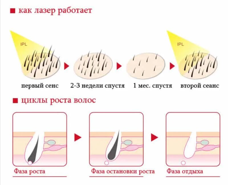 Как работает эпиляции. Фазы роста волос и лазерная эпиляция. принцип действия лазера для эпиляции. цикл роста волос. лазерная эпиляция схема.