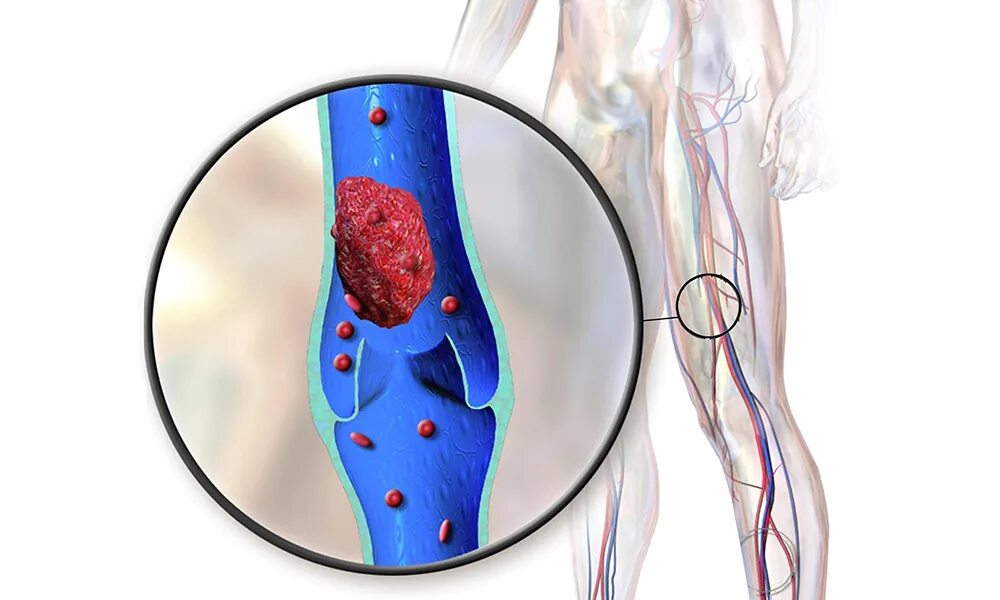 Как почистить тромбы. Септический тромбофлебит. Илеофеморальный венозный тромбоз.