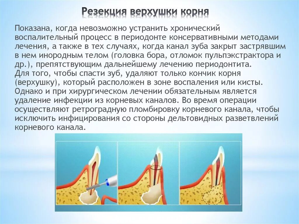 Резекция верхушки корня зуба. Показания к проведению операции резекция верхушки корня. Резекция верхушки корня методика. Цистоэктомия