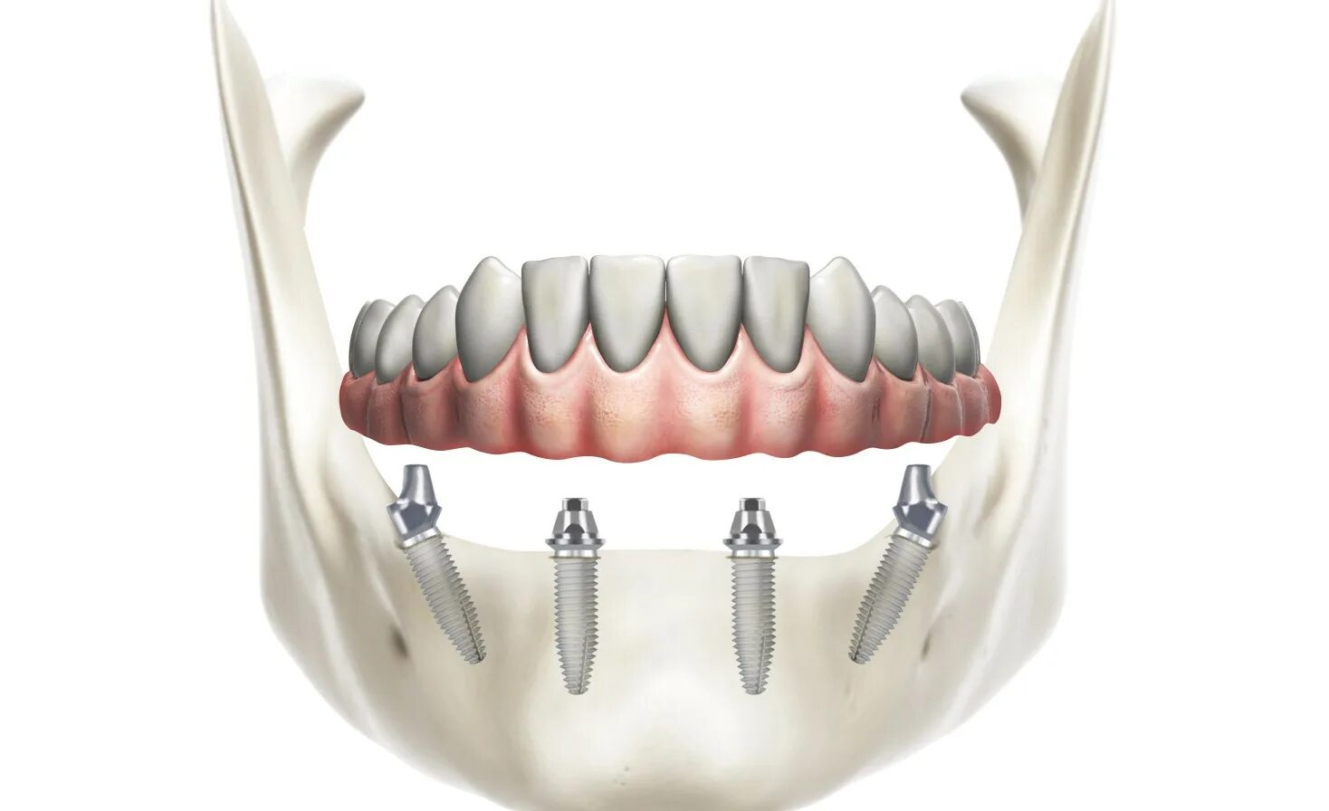 Имплантация "all on 6" Nobel Biocare (США-Швеция). Nobel all on 4 на верхней челюсти. Имплантация челюсти на 4 имплантах.