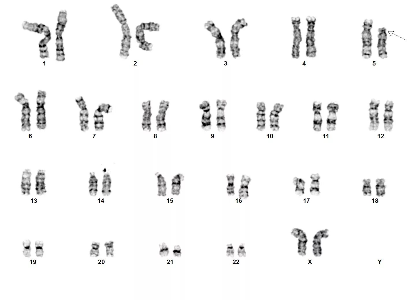 Кариотип при синдроме кошачьего крика. Кариотип синдрома кошачьего крика формула. Кариотип человека с синдромом кошачьего крика. Синдром Лежена кариотип. Мужская хромосома 5
