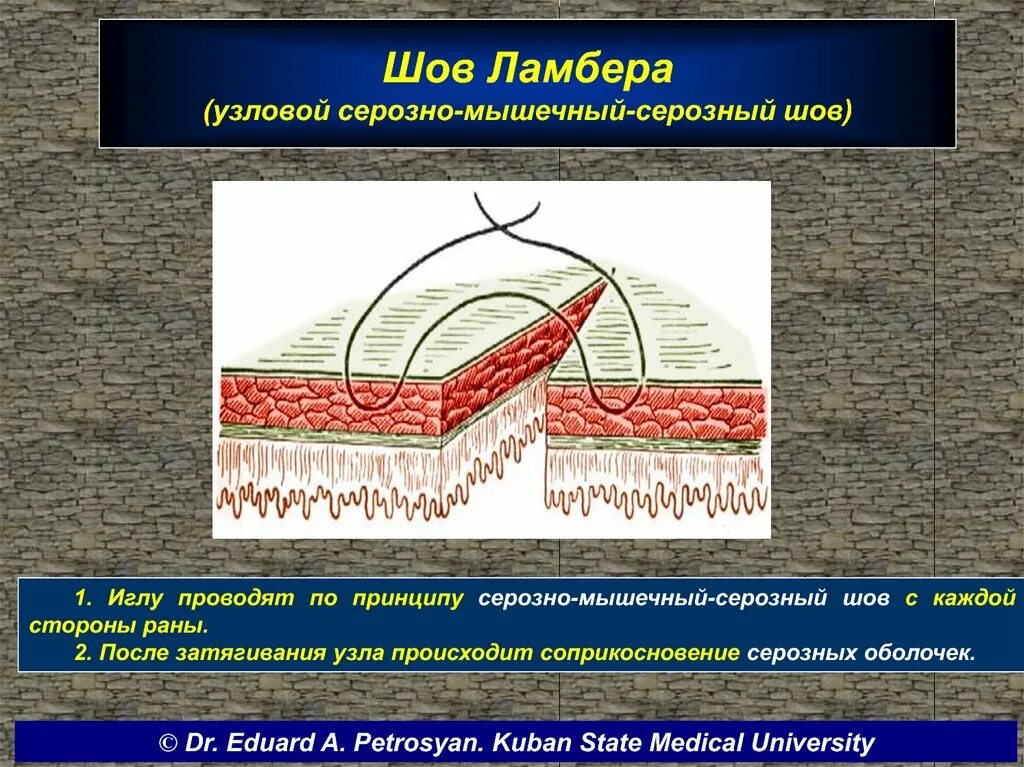 Воспаление серозной оболочки. Шов Ламбера. Шов Ламбера кишечный. Серозно серозный шов Ламбера.