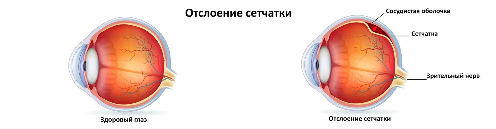 Регматогенная отслойка сетчатки. Первичная и вторичная отслойка сетчатки. Пломбирование отслойки сетчатки. Экссудативная отслойка сетчатки.