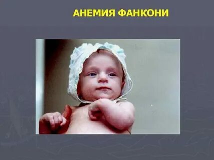 Анемия фанкони
