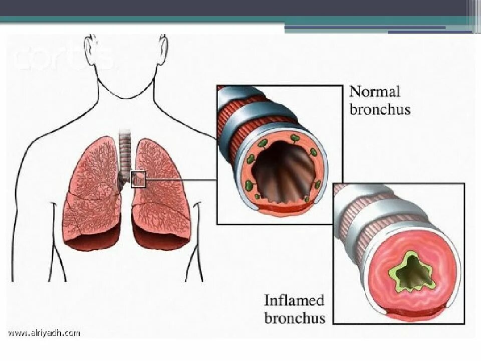 Бронхит заразен или. Бронхи при бронхиальной астме. Острый катаральный бронхит.