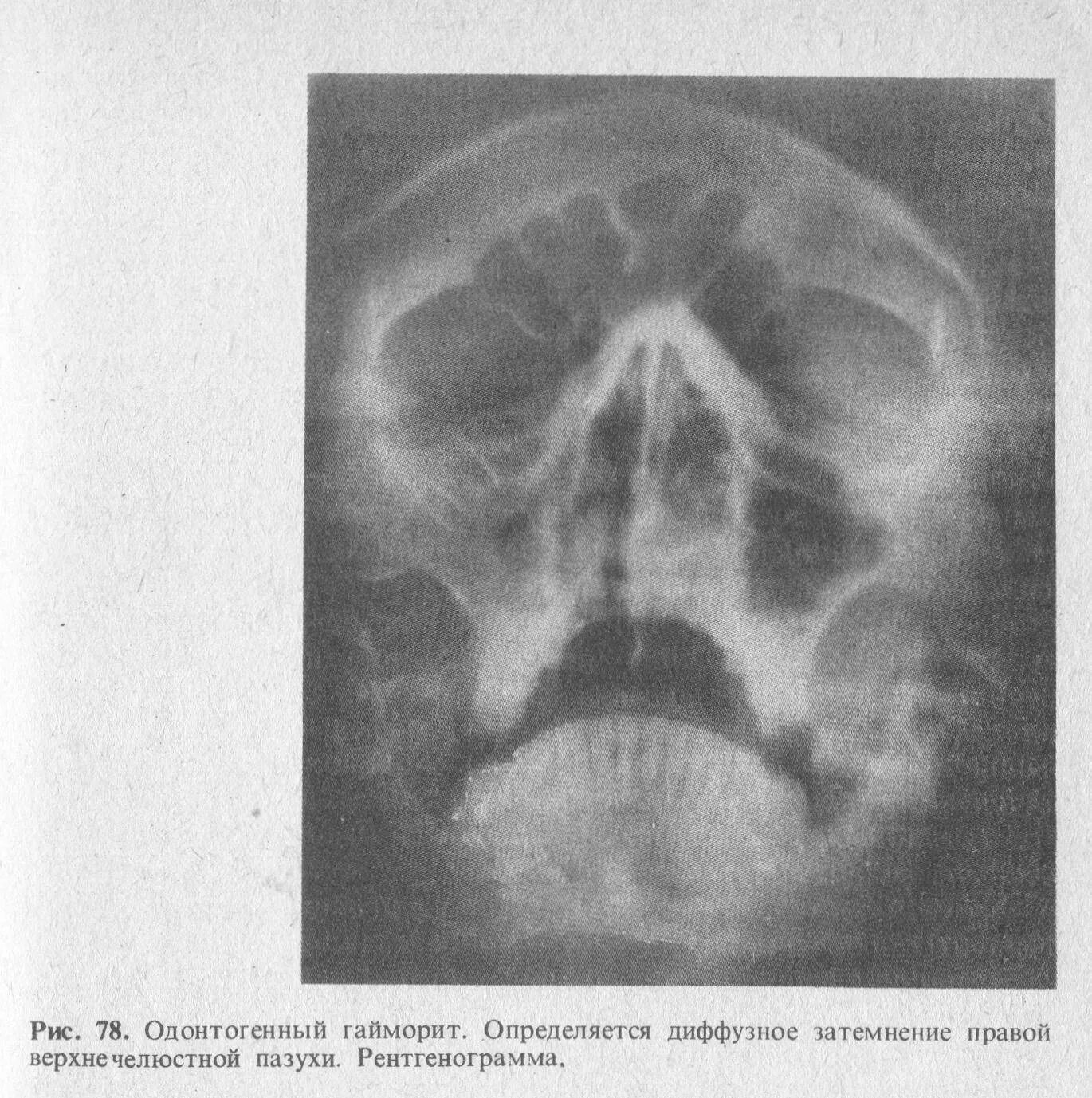 Пристеночное утолщение слизистой оболочки. Верхнечелюстной синусит рентген. Одонтогенный гайморит верхнечелюстной пазухи. Острый одонтогенный гайморит рентген. Острый одонтогенный верхнечелюстной синусит клиника.
