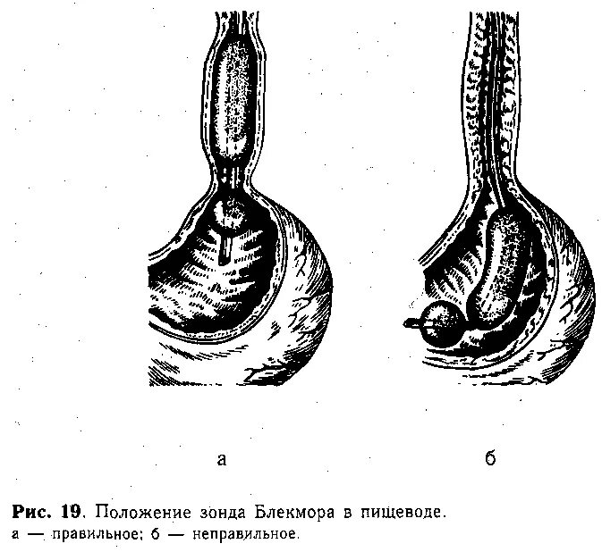 ВРВП -варикозное расширение вен пищевода. Зонд пищеводный. Кровотечение из расширенных вен пищевода.