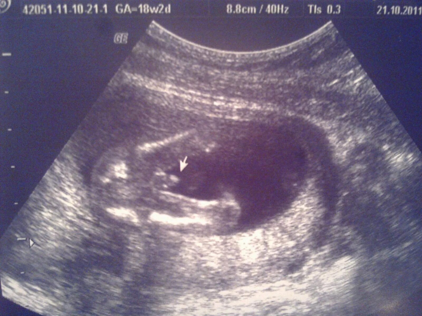 16 недель беременности размер плода. 16 недель беременности фото плода. Узи ребенка на 16 неделе беременности. 15-16 недель беременности. Ребенок в животе 16 недель.