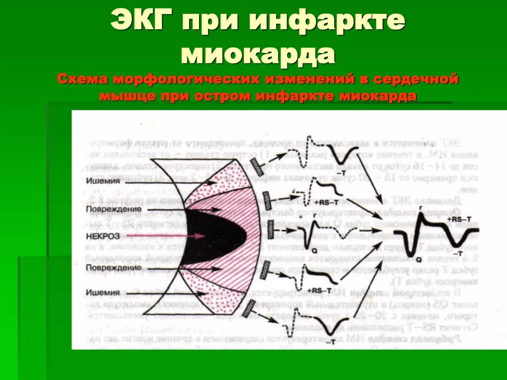 Схема инфаркта миокарда на ЭКГ. Острый инфаркт миокарда кардиограмма. Изменения на ЭКГ остром инфаркте миокарда. Изменения на кардиограмме при инфаркте миокарда. Зона ишемии