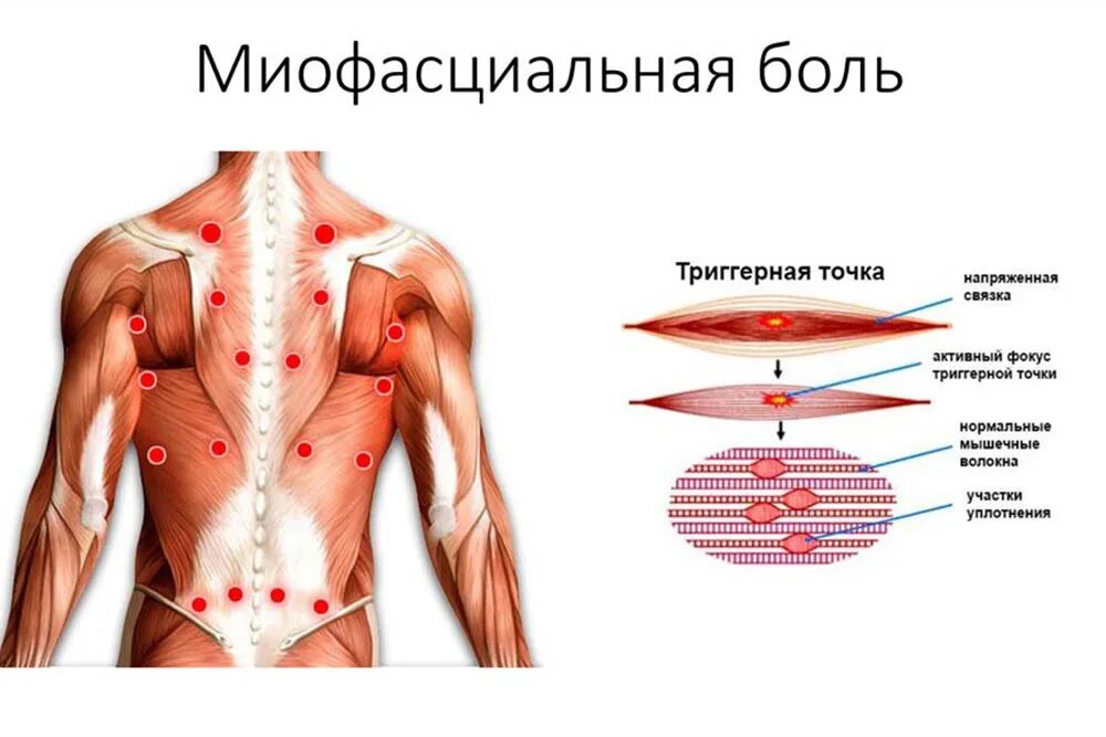 Миофасциальные дисфункции. Миофасциальный болевой синдром триггерные точки. Миофасциальный синдром триггерные точки спины. Триггерные точки в мышцах спины. Мышцы спины триггерные точки человека анатомия.