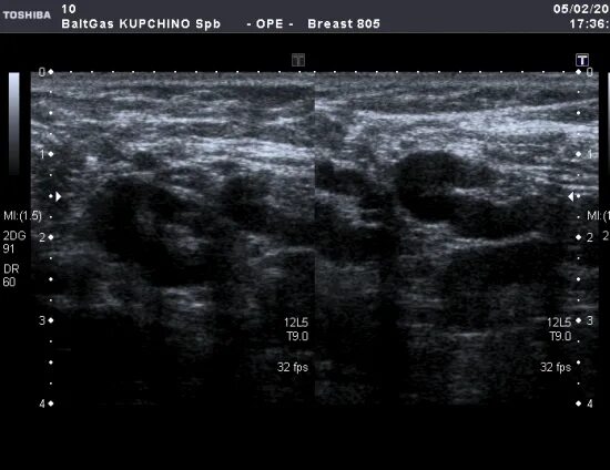 Лимфаденопатия маммография. Интрамаммарный лимфоузел молочной железы на УЗИ. УЗИ картина лимфаденопатии. Аксиллярная лимфаденопатия молочной