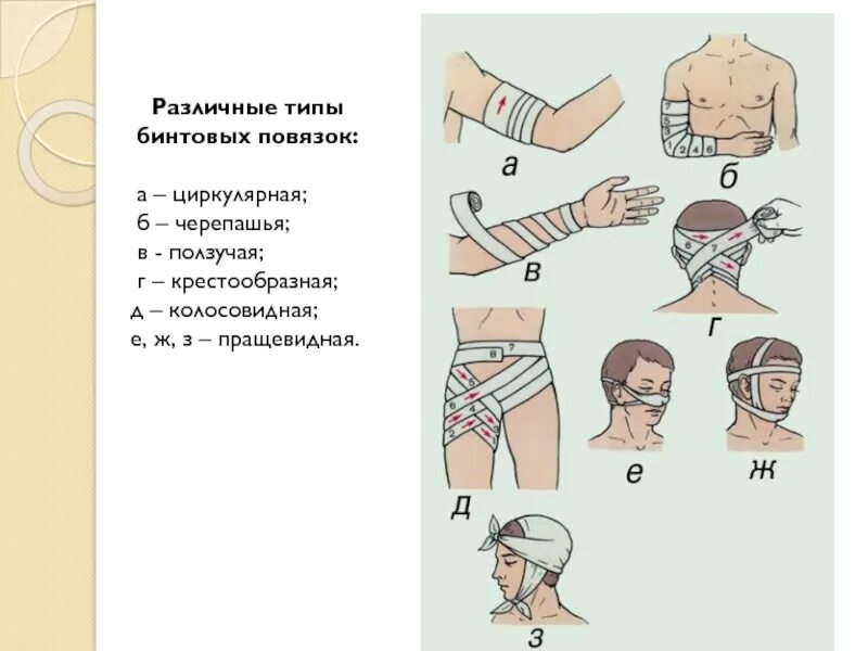 Основные типы повязок. Типы бинтовых повязок пращевидная. Типы бинтования повязок. Типы бинтовых повязок таблица. Бинтовые повязки повязки.