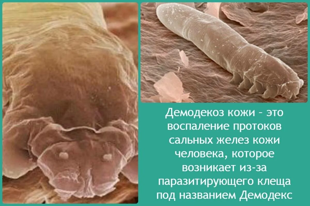 Подкожный клещ рода демодекс. Глазные клещи демодекс