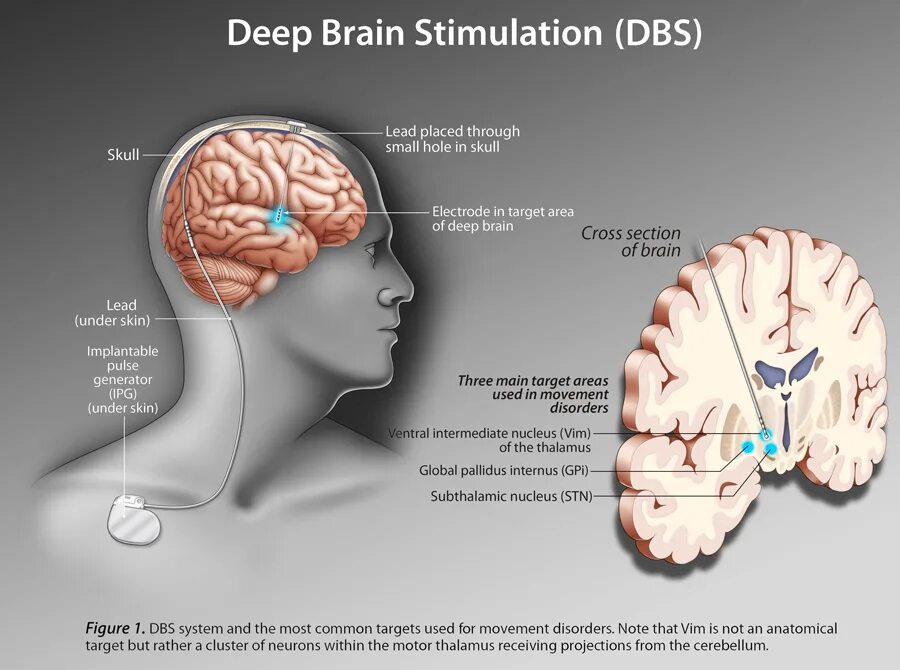 Deep brain. Глубокая стимуляция головного мозга. Стимулирует мозг. Глубокая стимуляция мозга DBS.