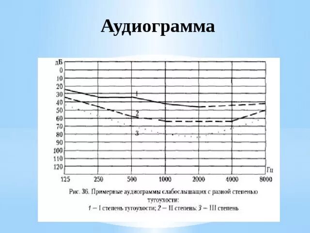 Аудиометрия является методом исследования. Аудиометрия слуха норма таблица. Аудиограмма слуха ребенку. Аудиограмма 3 степени тугоухости. Аудиограмма слуха ребенку.