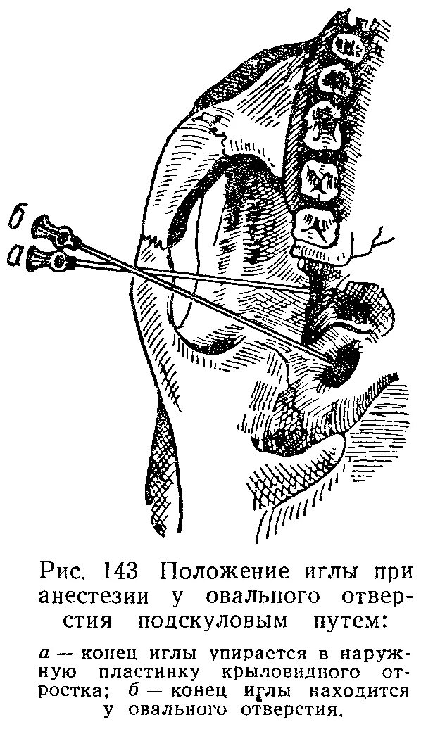 Блокада тройничного. Анестезия у овального отверстия по Вайсблату. Стволовая анестезия подскуловой путь. Обезболивание нижнечелюстного нерва. Туберальная анестезия по Вайсблату.