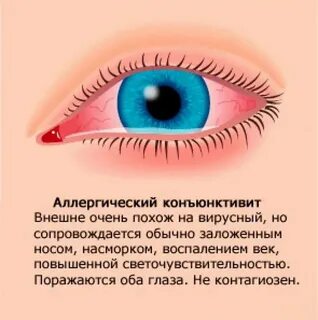 Как вылечить коньюктивит
