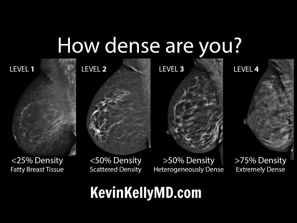 Плотный степень. Типы строения молочной железы маммография. Плотность молочной железы на маммографии. Структура молочной железы маммография. Плотность ткани молочной железы.
