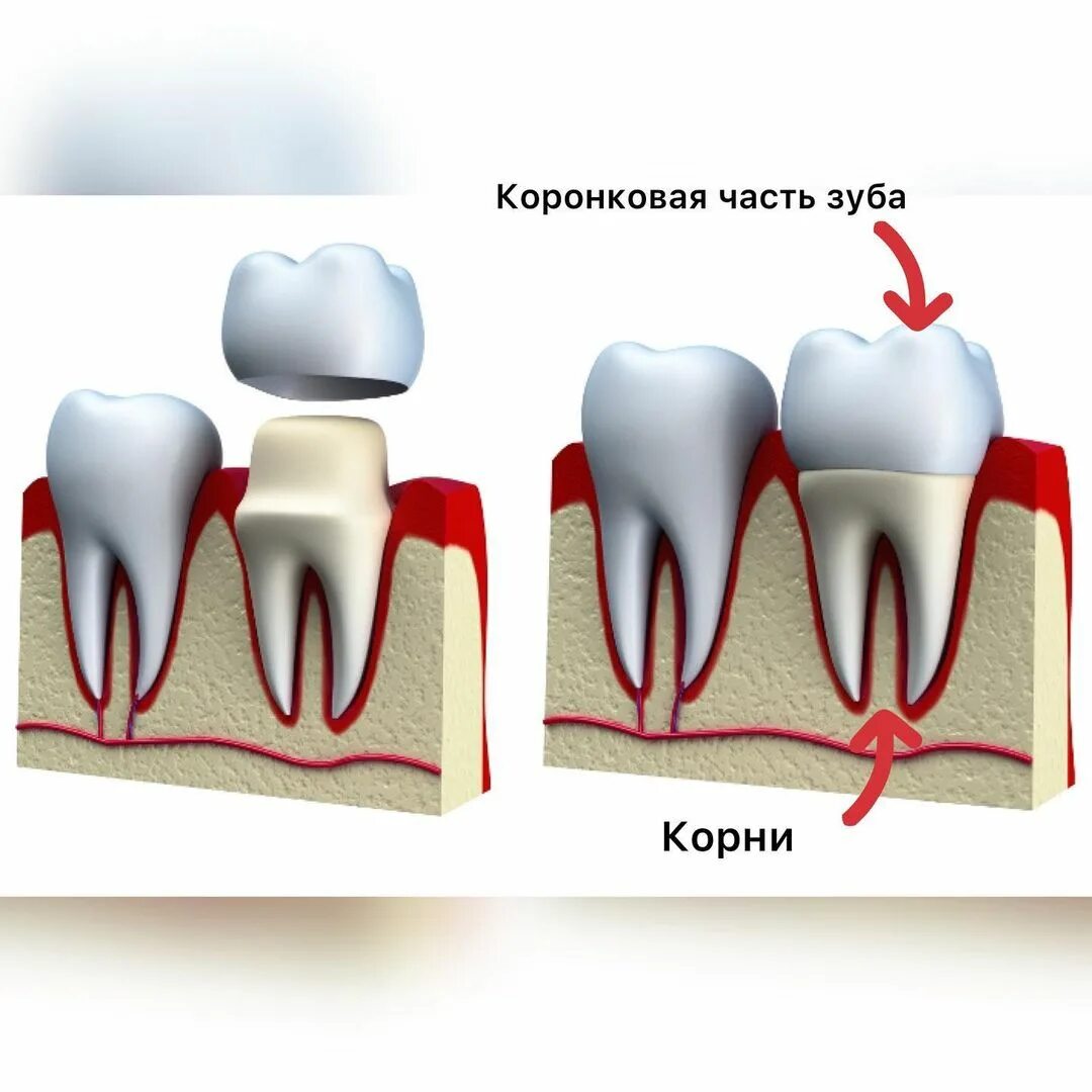 Протезирование депульпированного зуба. Пломбировка корневых каналов. Протезирование депульпированного зуба. Пульпита (депульпирование зуба. Протезирование депульпированного зуба.
