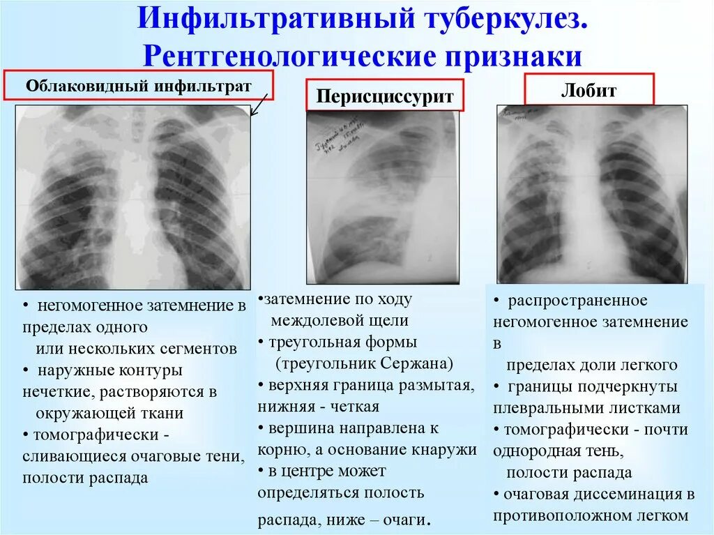 Лобить. Инфильтративный туберкулёз лёгких рентген. Инфильтративный туберкулез легких рентген. Инфильтративный туберкулёз рентген симптомы. Очагово-инфильтративный туберкулез рентген.