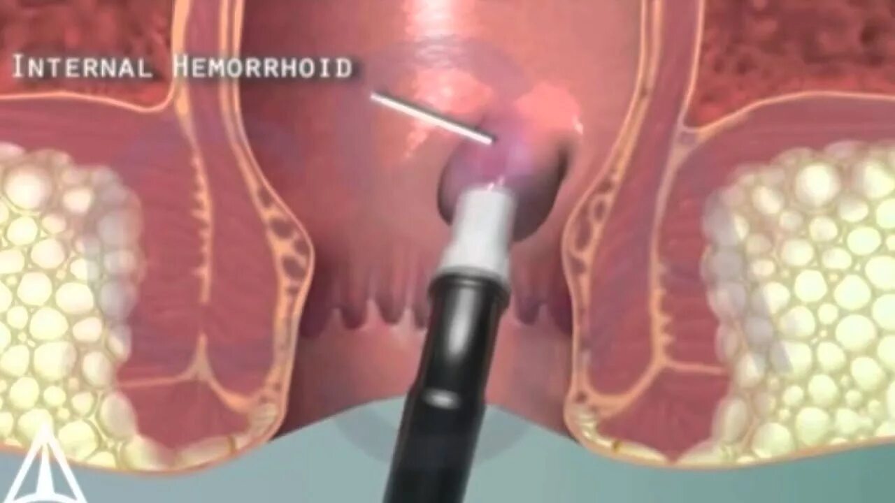 Анальная трещина год. Комбинированный геморрой.
