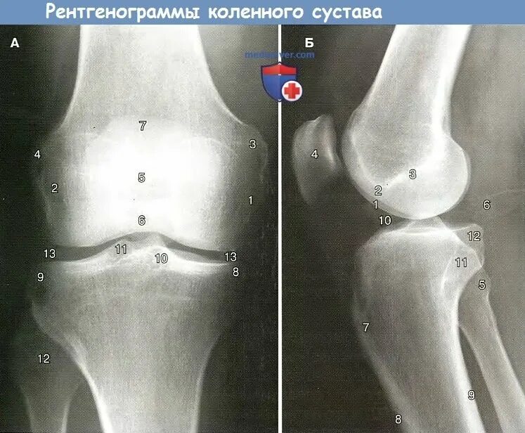 Коленный сустав рентген анатомия. Коленный сустав рентген норма. Строение коленного сустава рентген. Рентген коленного сустава в боковой проекции норма. Хондромаляция медиальных мыщелков