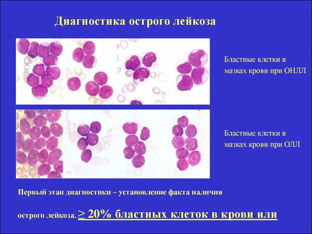 Мазок крови при выявлении патологии что это. Бластные клетки в крови при лейкозе. Изучение мазков крови при остром лейкозе.. Бластные клетки мазок крови. Острый лейкоз мазок крови.
