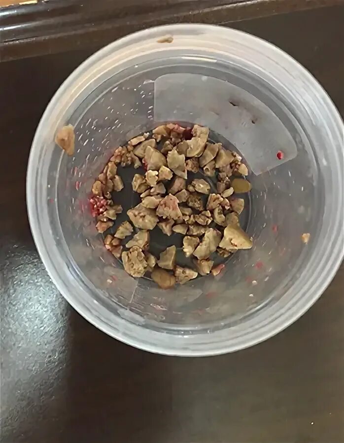 Неинвазивная литотрипсия,. Перкутанная нефролитотрипсия. Камень в чашечно лоханочной системе. Дробилка для почечных камней. Аппарат для дробления камней в почках литотрипсия.