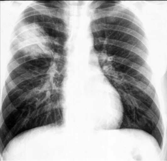 правосторонняя верхнедолевая сегментарная плевропневмония. сегментарная пневмония рентген. правосторонняя сегментарная пневмония. правосторонняя полисегментарная пневмония рентген. пневмония правосторонняя s4 s5.