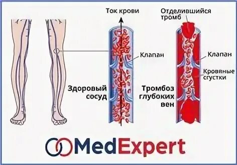 Тромбоз глубоких вен нижних конечностей. Окклюзионный флеботромбоз нижних конечностей. Тромбоз глубоких вен (ТГВ) – что это такое?. Тромбоз глубоких вен нижних конечностей клиника. Размеры тромбов