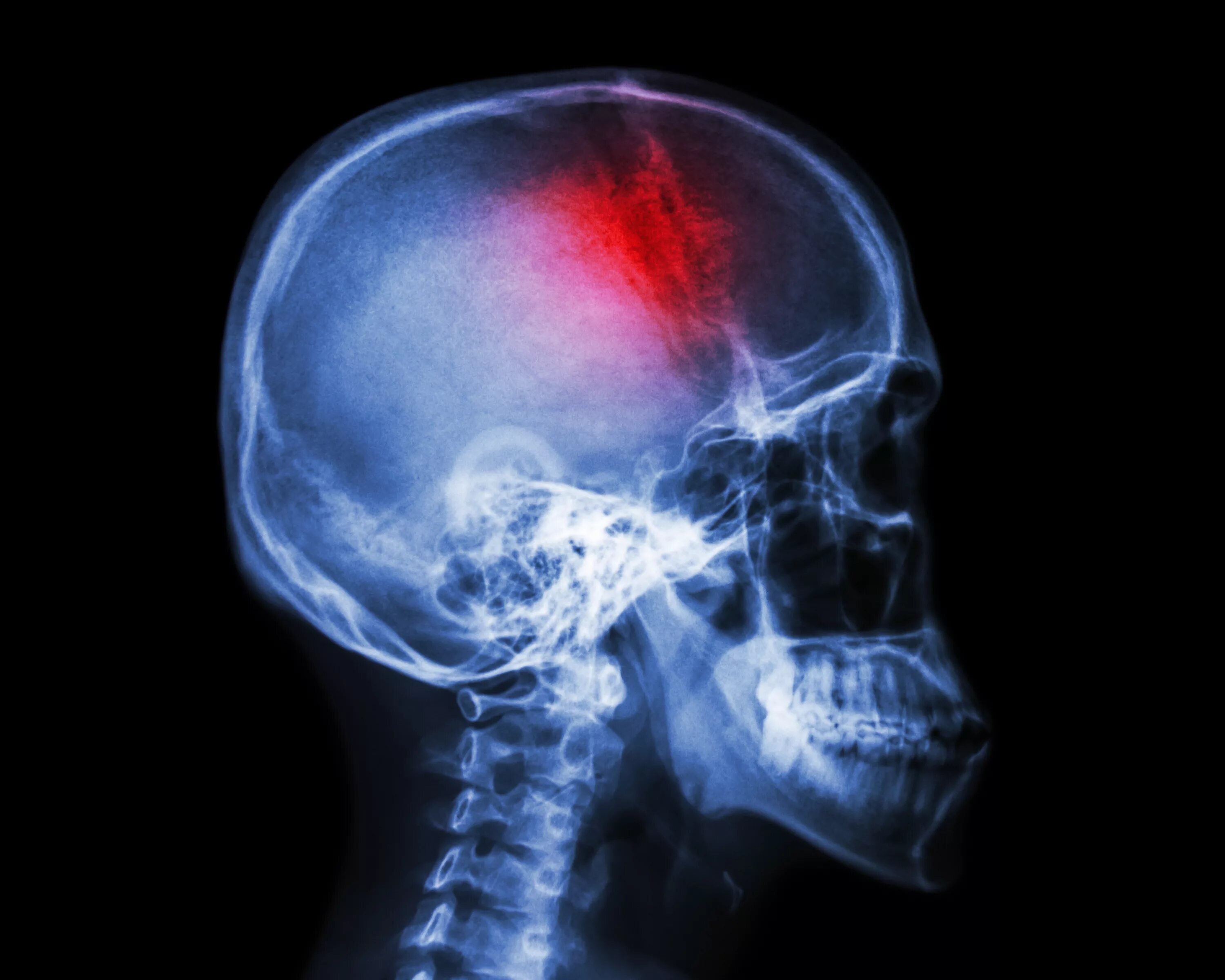 Рентгеновские снимки черепа. Мозги без черепа