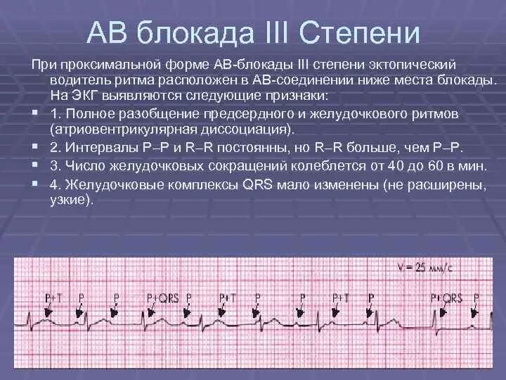 Полная атриовентрикулярная блокада. Полная атриовентрикулярная блокада 3 степени на ЭКГ. Признаки av блокады 3 степени на ЭКГ. Атриовентрикулярная блокада II степени. ЭКГ признаки АВ-блокады III степени.