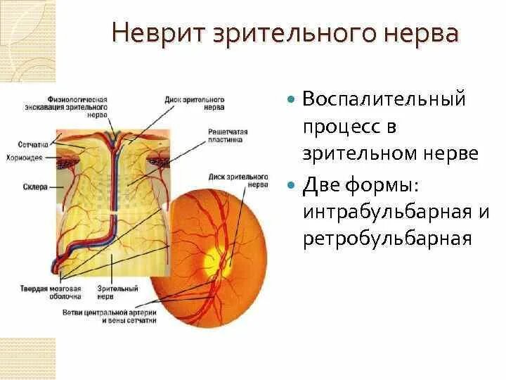 Ретробульбарный неврит зрительного нерва офтальмология. Клиника поражения зрительного нерва. Неврит зрительного нерва симптомы. Односторонний оптический неврит.