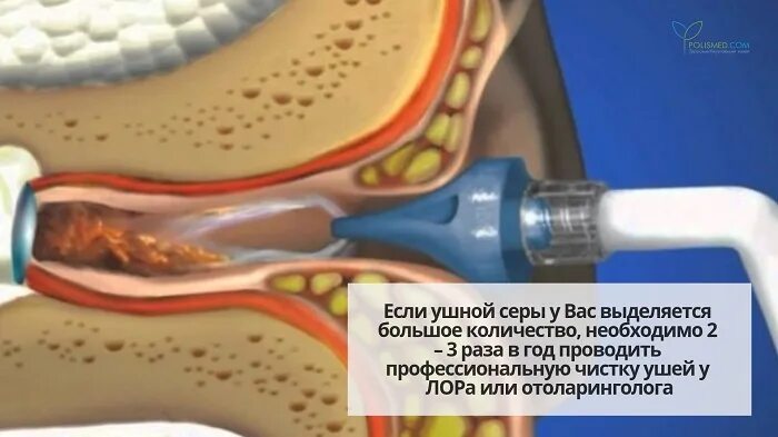 Почему образуется сера. Профессиональная чистка ушей.