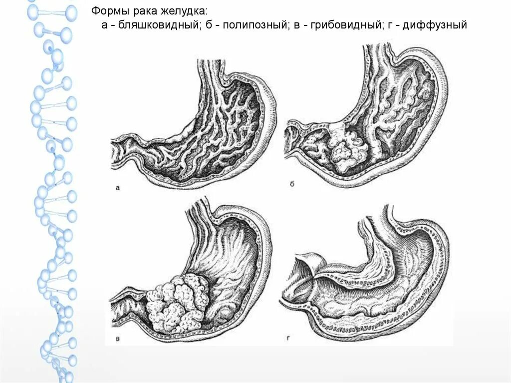 Как определить стадию рака желудка. Грибовидная опухоль желудка. Пенетрация язвы желудка. Патанатомия пенетрации язвы. Блюдцеобразная опухоль желудка.