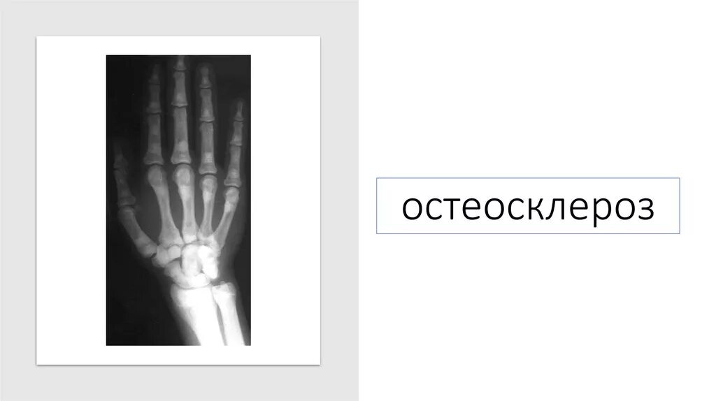 Остеосклероз симптомы. Остеосклероз симптомы
