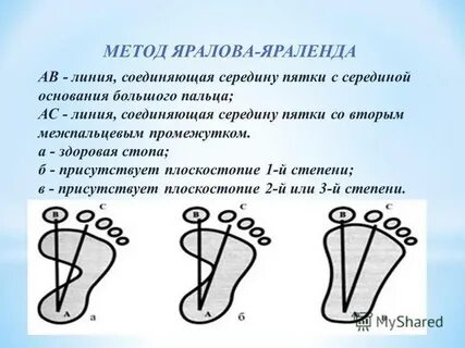 Характеристика плоскостопия москва
