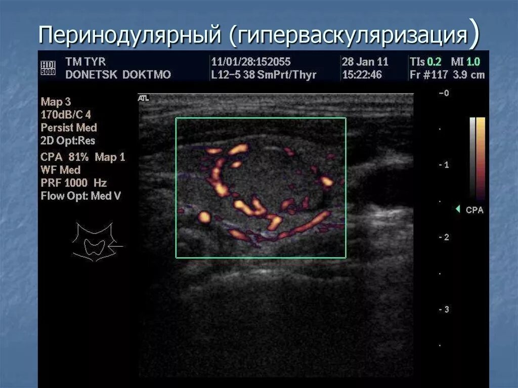 Васкуляризация усилена. Перинодулярный кровоток узла щитовидной. Перинодулярный кровоток узла щитовидной усилен. Интранодулярный кровоток в узле щитовидной железы. ЦДК кровоток щитовидной железы.