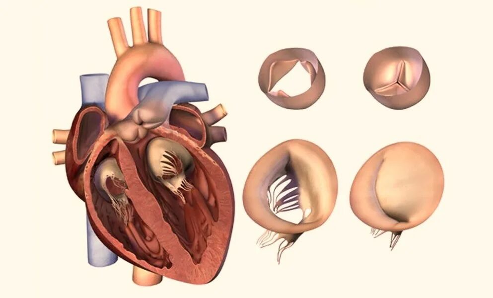 Комбинированный сочетанный митральный порок сердца. Приобретенные митральные пороки сердца. Комбинированный митрально-аортальный порок сердца. Комбинированный порок митрального клапана.