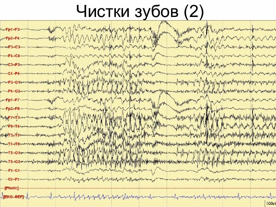 Артефакт ЭКГ на ЭЭГ. Физиологические артефакты ЭЭГ. Артефакт миографии на ЭЭГ. Миографические артефакты на ЭЭГ что это такое. Записаться на ээг