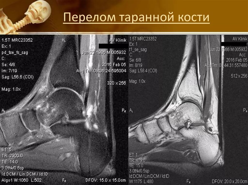 Краевой перелом заднего края таранной кости. Перелом таранной кости мрт. Перелом отростка таранной кости. Краевой перелом таранной кости рентген.