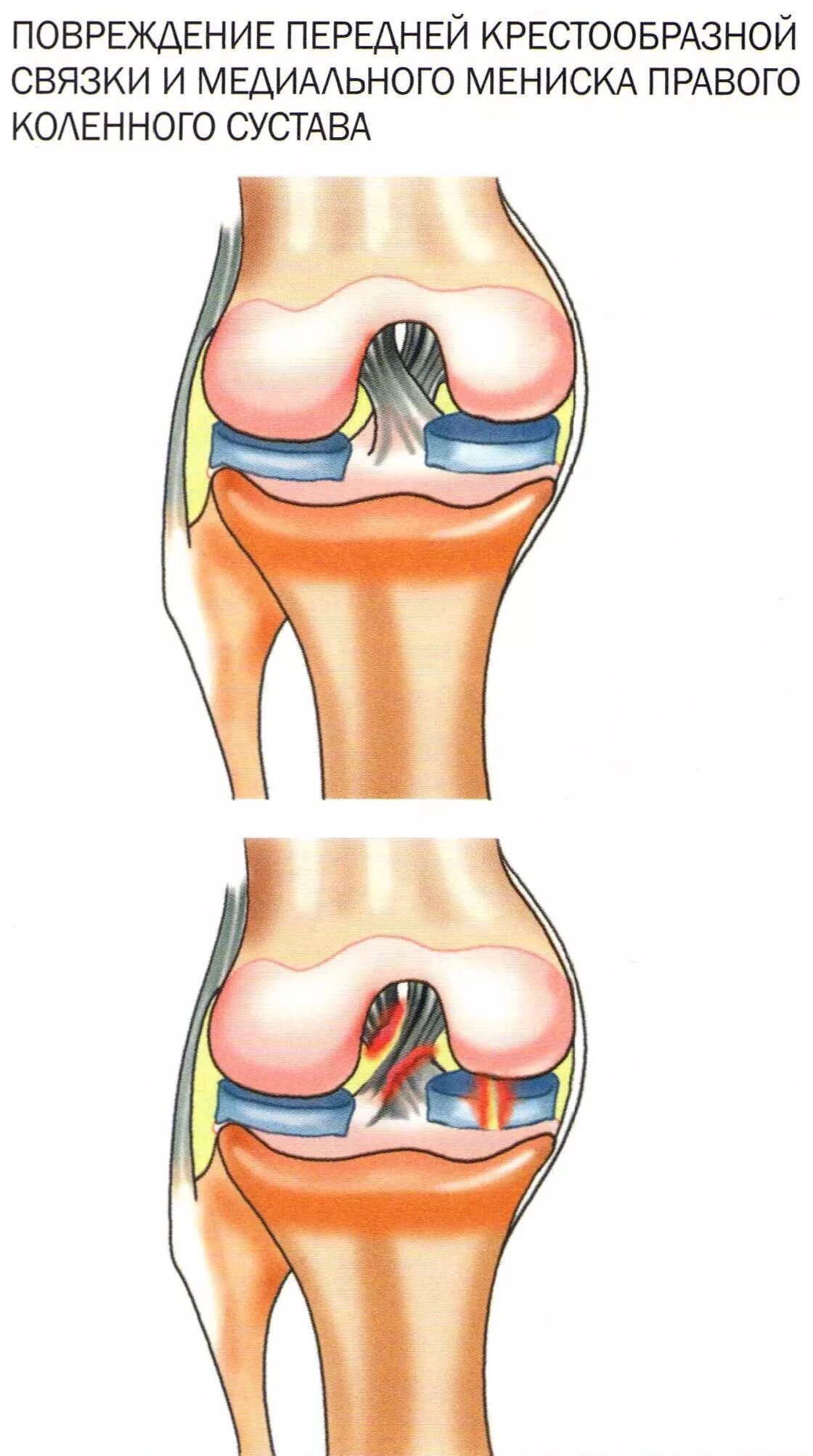 Мениск коленного сустава. Перерастяжение связок коленного сустава. Разрыв связок и мениска коленного сустава. Повреждение мениска коленного сустава симптомы.