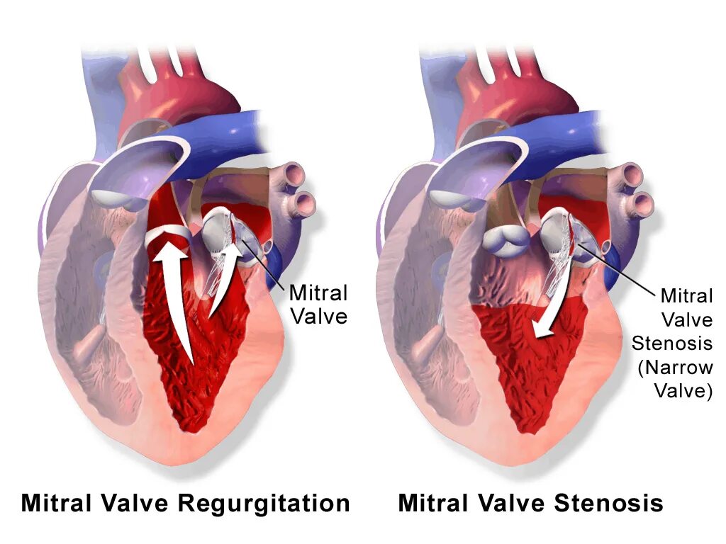 Сердечная недостаточность митрального клапана. Ревматический митральный стеноз макропрепарат. Митральный стеноз и пролапс митрального клапана. Митральный стеноз сердца гемодинамика. Стеноз митрального клапана.