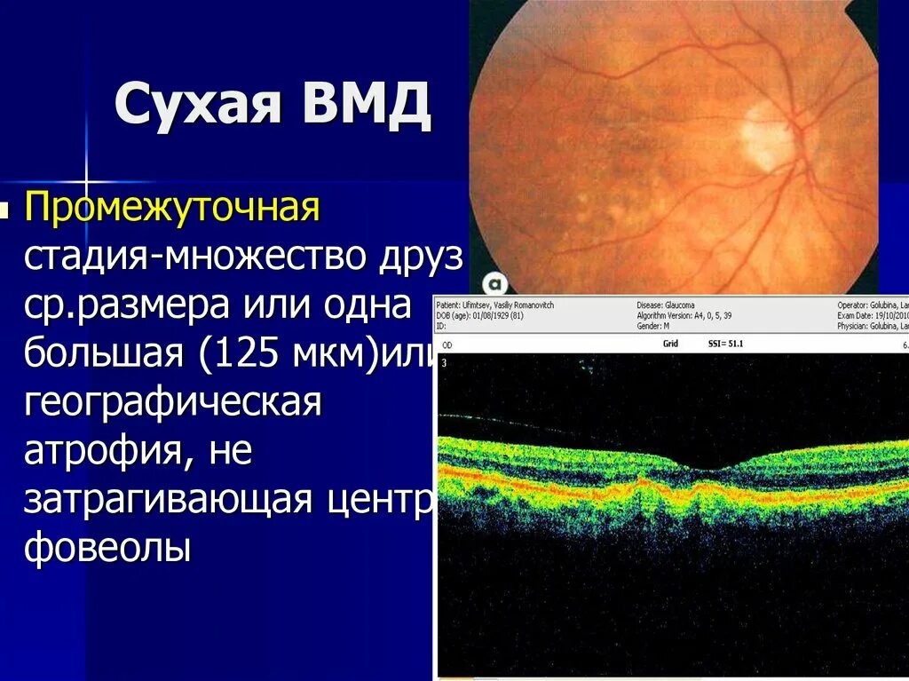 Макулодистрофия друзы. Возрастная макулярная дегенерация сетчатки. Макулярной дистрофии сетчатки. Возрастная макулярная дегенерация формы. Диагноз сетчатки