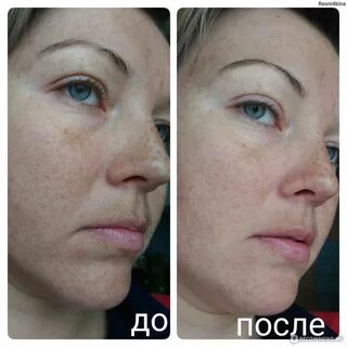 Новакутан отзывы