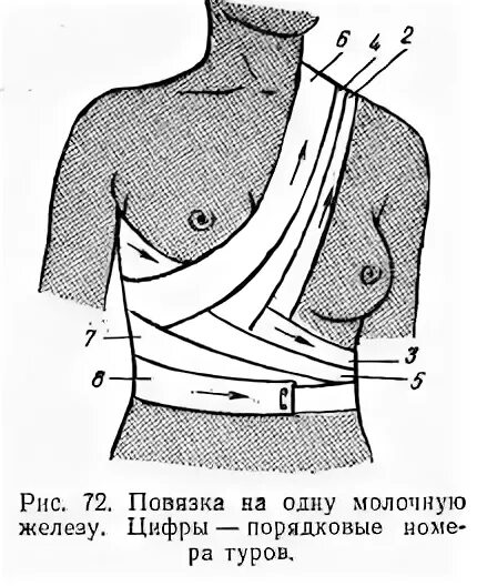 Повязка на молочные железы алгоритм. Десмургия повязка на молочную железу. Наложение повязки на молочную железу алгоритм. Поддерживающая повязка на молочную железу. Повязка Вельпо на молочную железу.