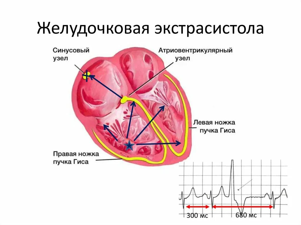 Желудочковые экстрасистолы что это такое у взрослых